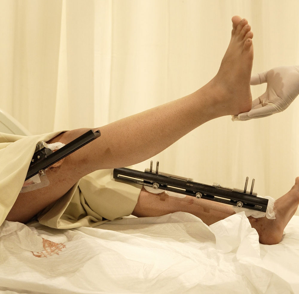 CARENURSE Height Increase Surgery in Gurgaon India